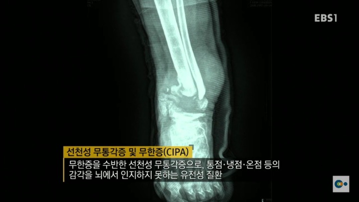 아픔을 느낄 수 없다면 좋은걸까? 무통증 환자 삼남매 이야기. #2 | 인스티즈