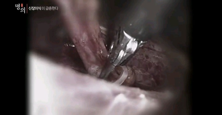 신장 적출 수술 과정.jpg (사진주의) | 인스티즈